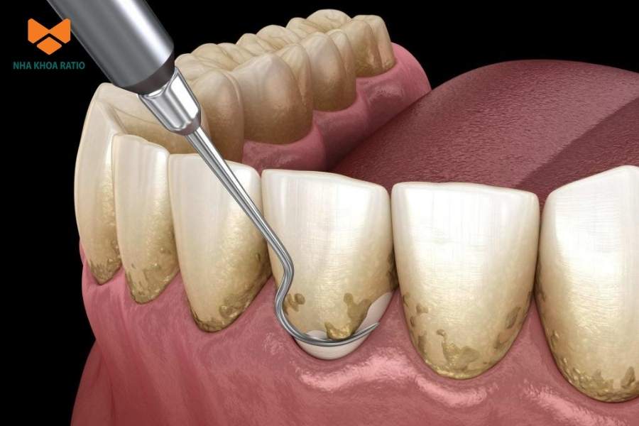 Người có mảng bám hoặc cao răng tích tụ nên thăm khám và cạo vôi răng định kỳ