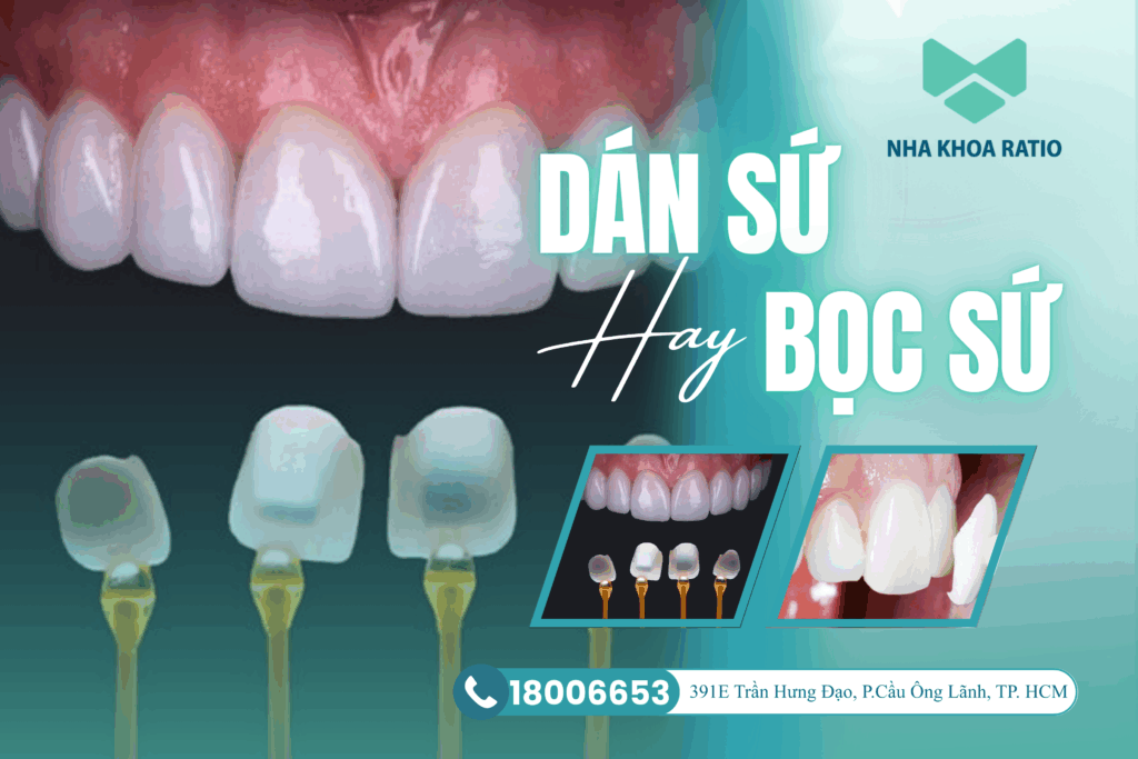Bọc Sứ hay Dán Sứ