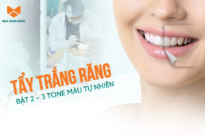 Tẩy trắng răng tại nha khoa Ratio, răng trắng bật 2-3 tone