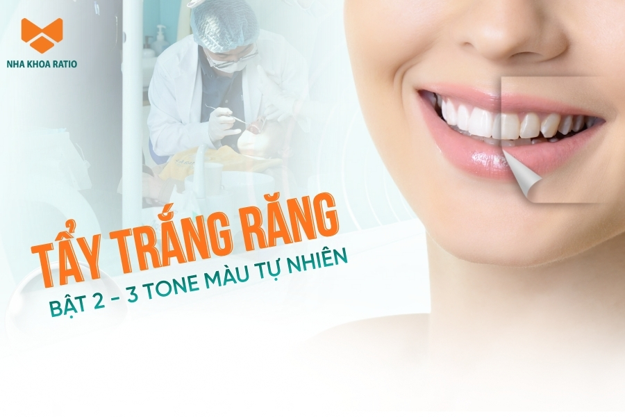 Tẩy trắng răng tại nha khoa Ratio, răng trắng bật 2-3 tone