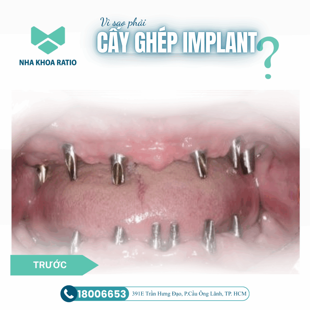 Cấy ghép Implant Cấy ghép Implant