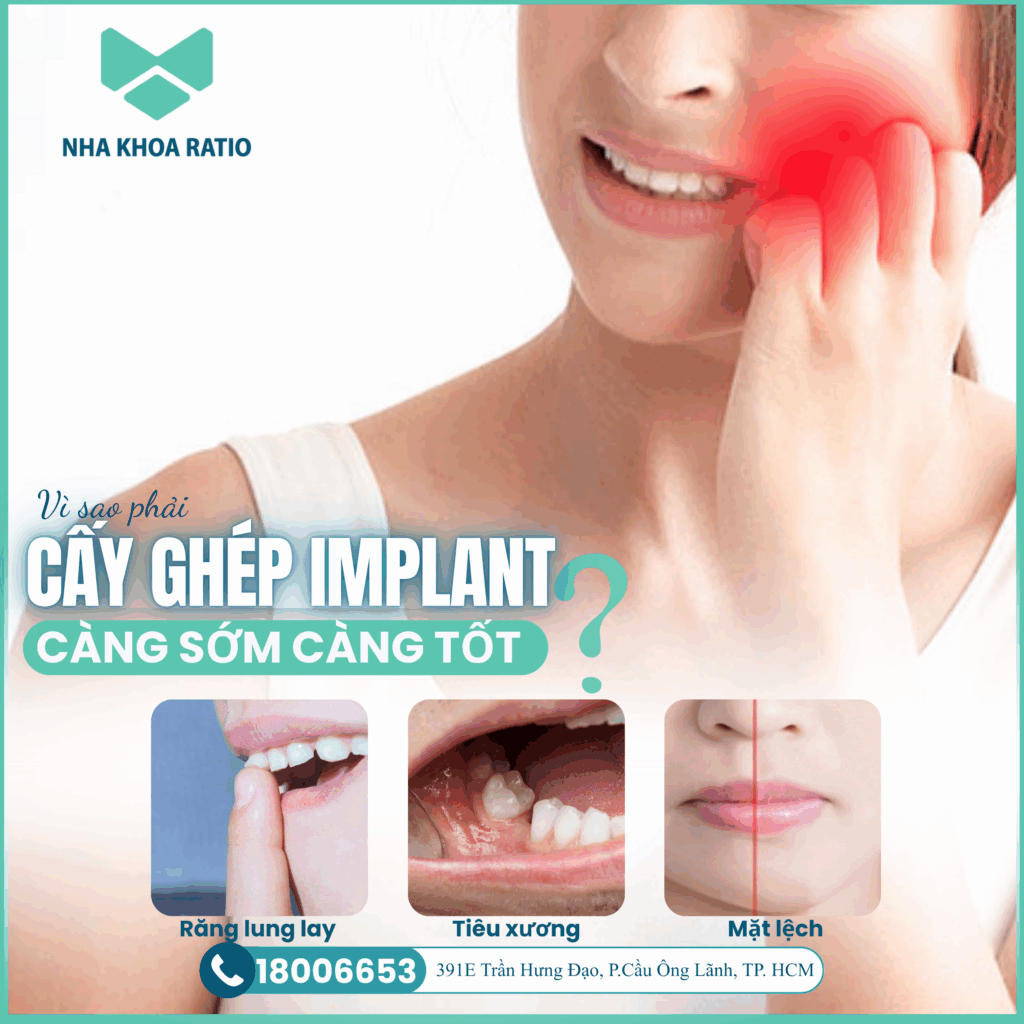Cấy ghép Implant Cấy ghép Implant