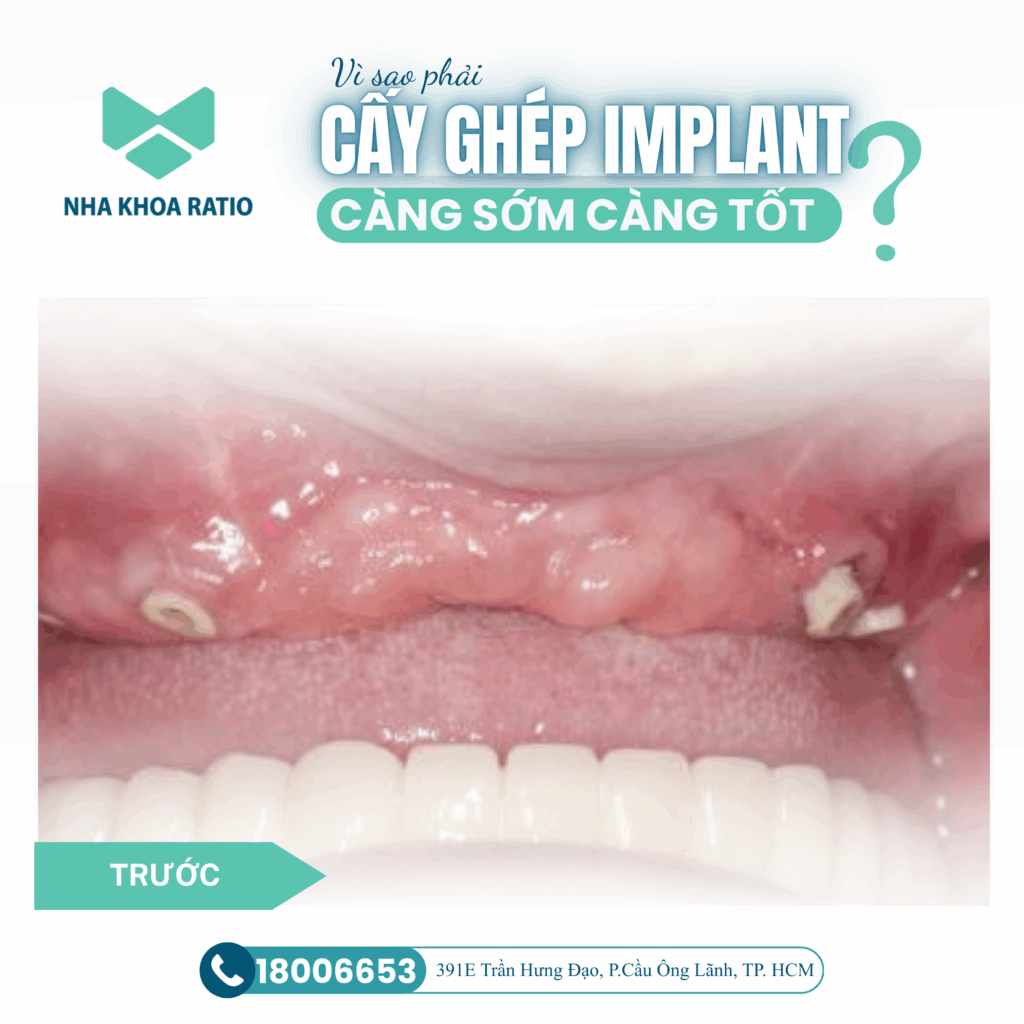 Cấy ghép Implant Cấy ghép Implant