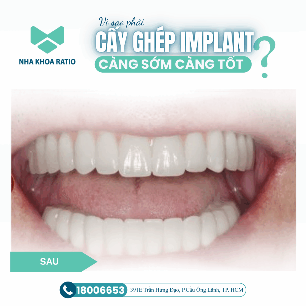 Cấy ghép Implant Cấy ghép Implant