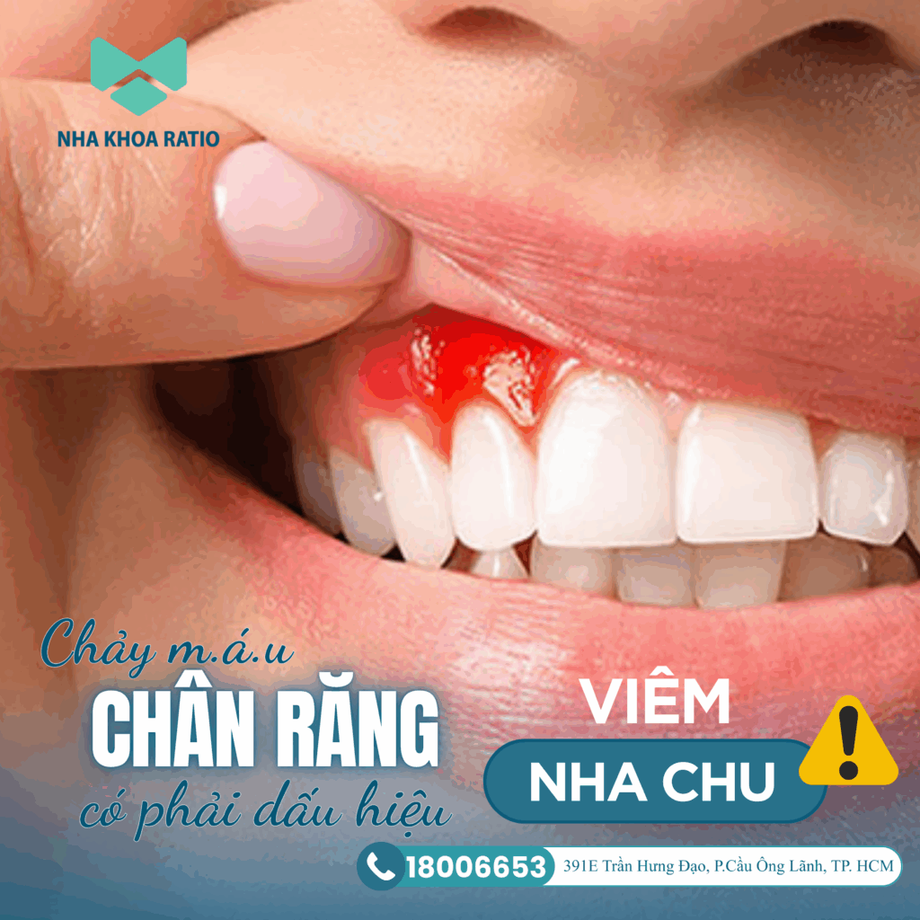 Chảy máu chân răng có thể gây viêm nha chu