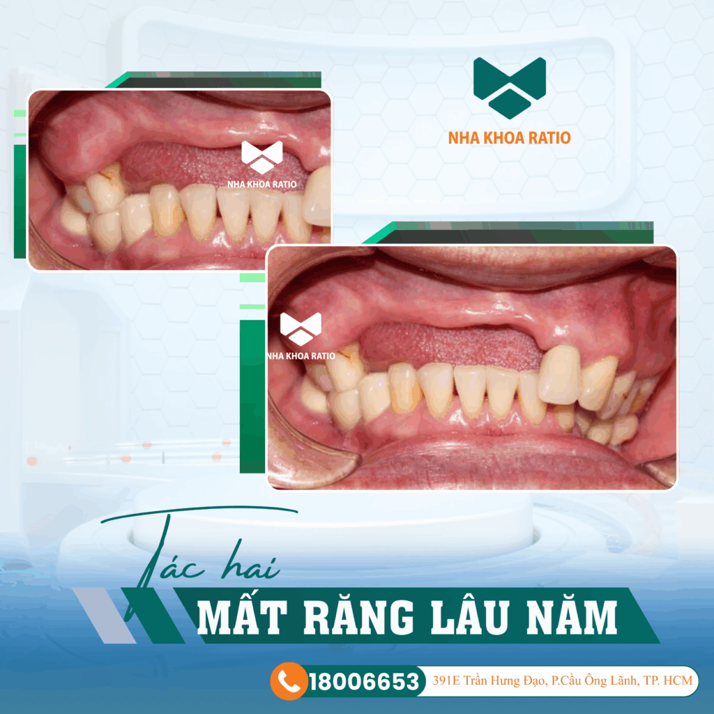 mất răng lâu năm