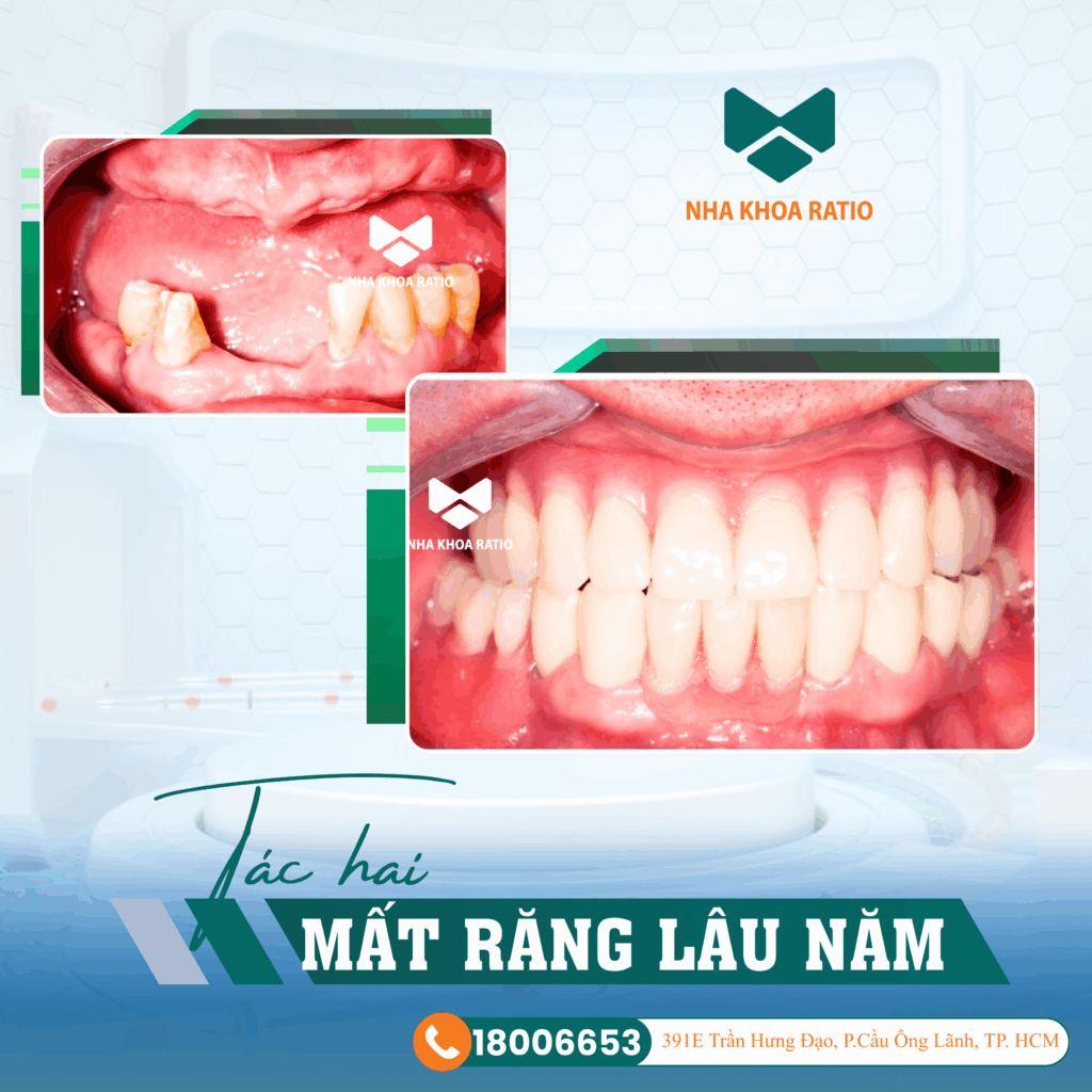 mất răng lâu năm