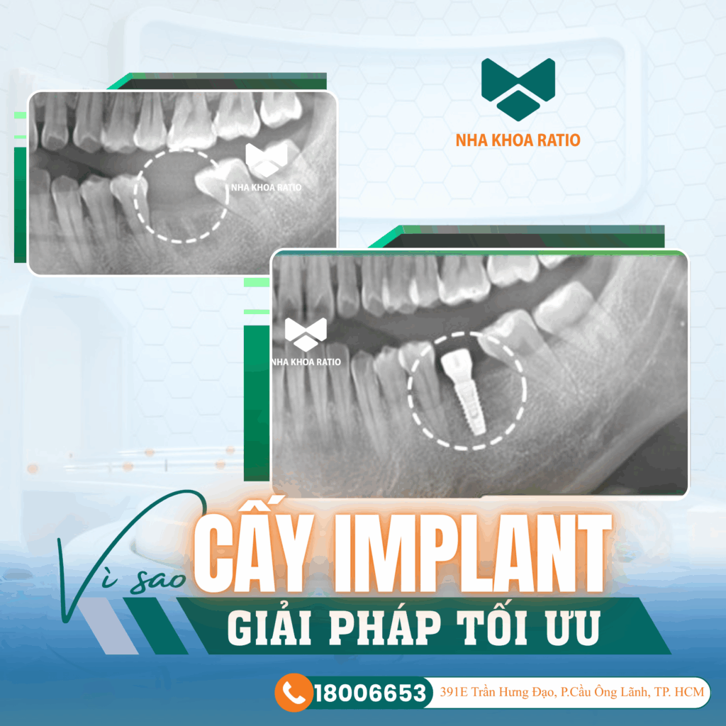 mất răng lâu năm