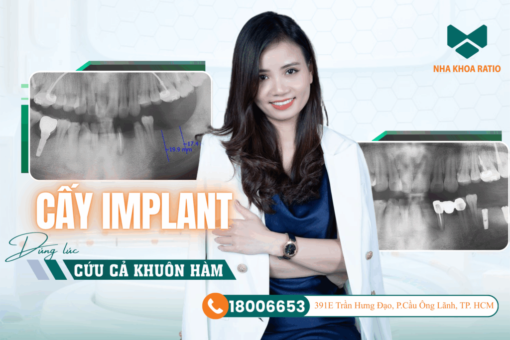 cấy Implant