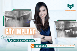 cấy Implant