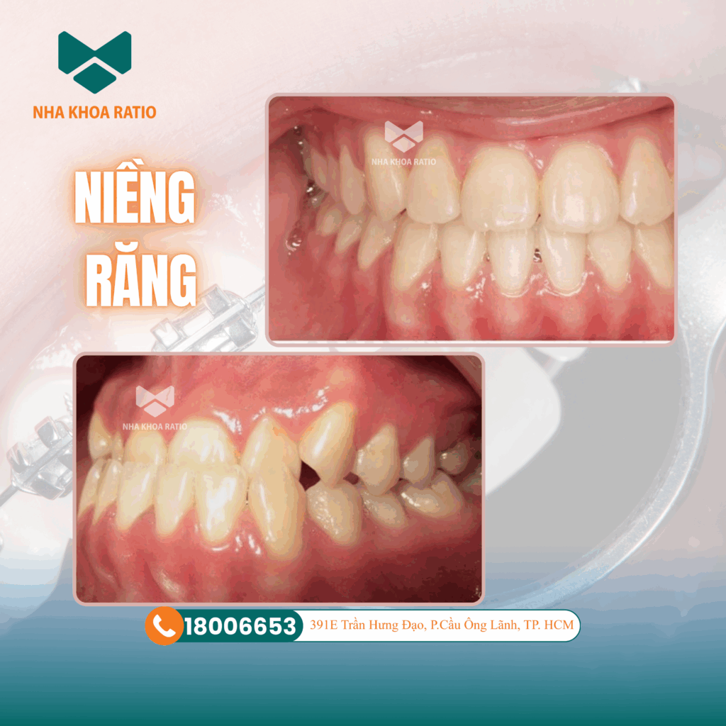 Niềng răng. Nha khoa Ratio 
