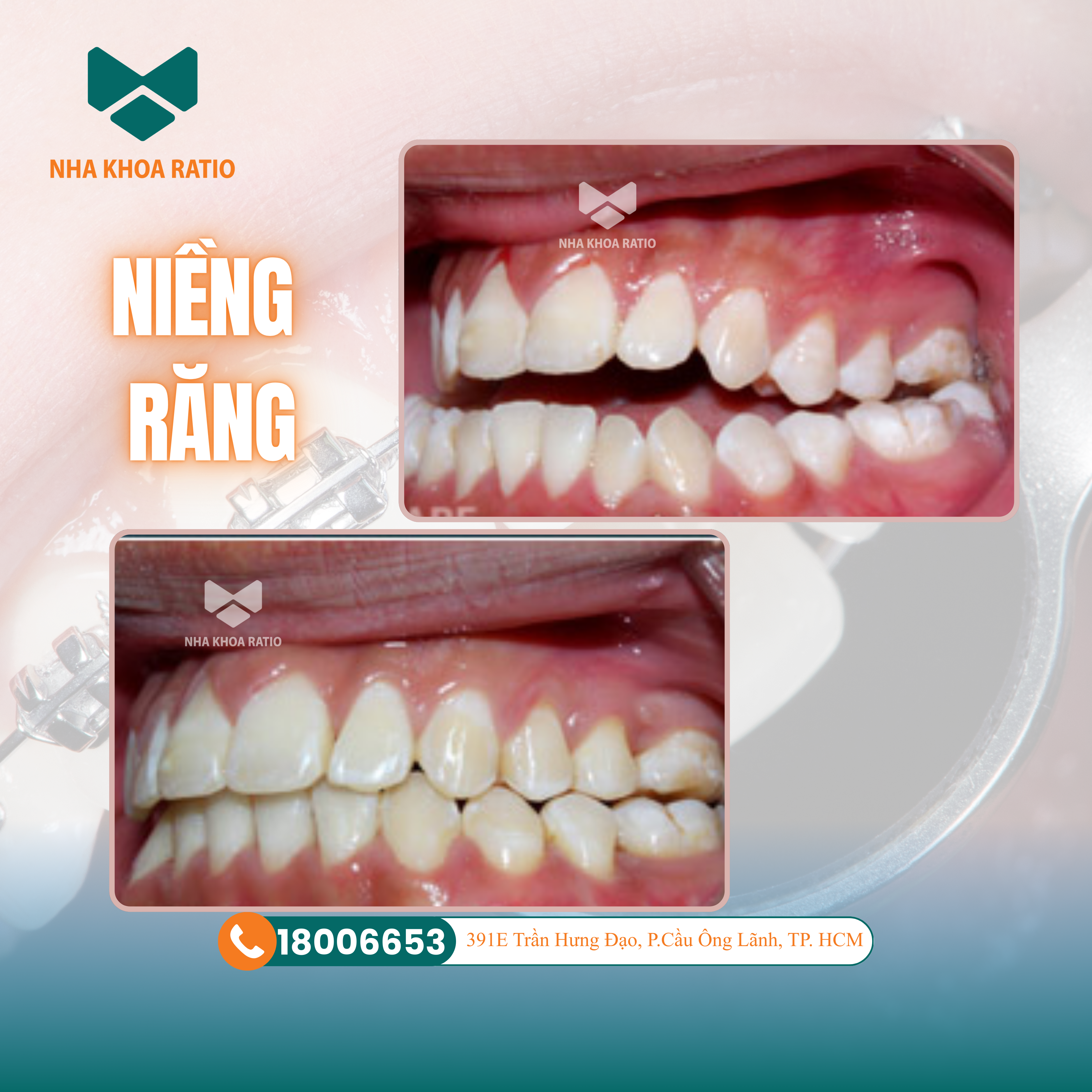 Niềng răng. Nha khoa Ratio 