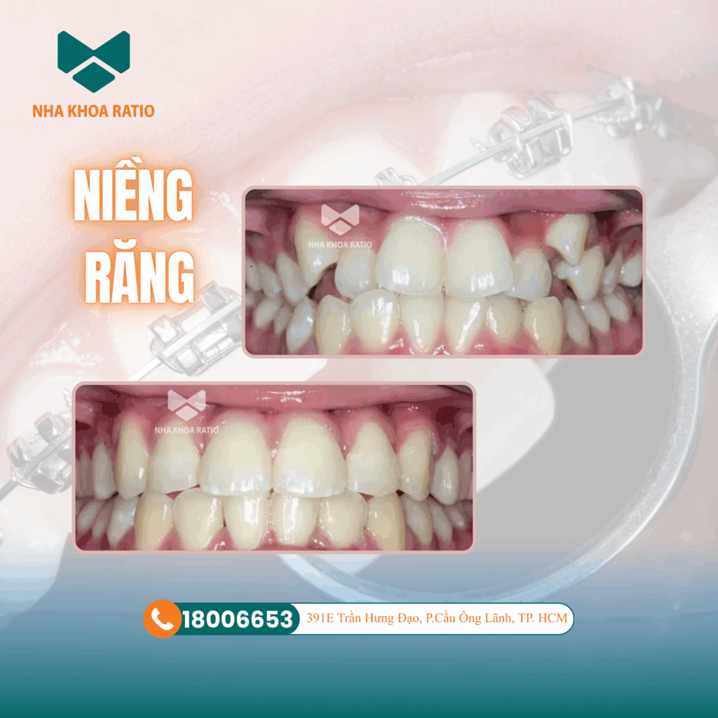 Niềng răng. Nha khoa Ratio 