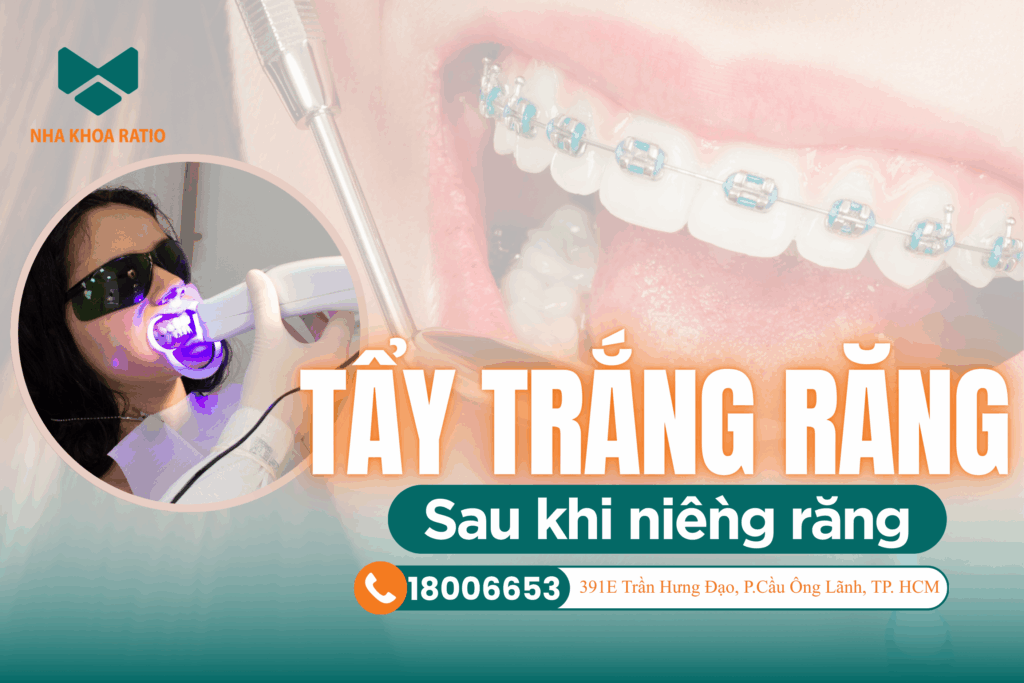 Tẩy trắng răng - Nha khoa Ratio