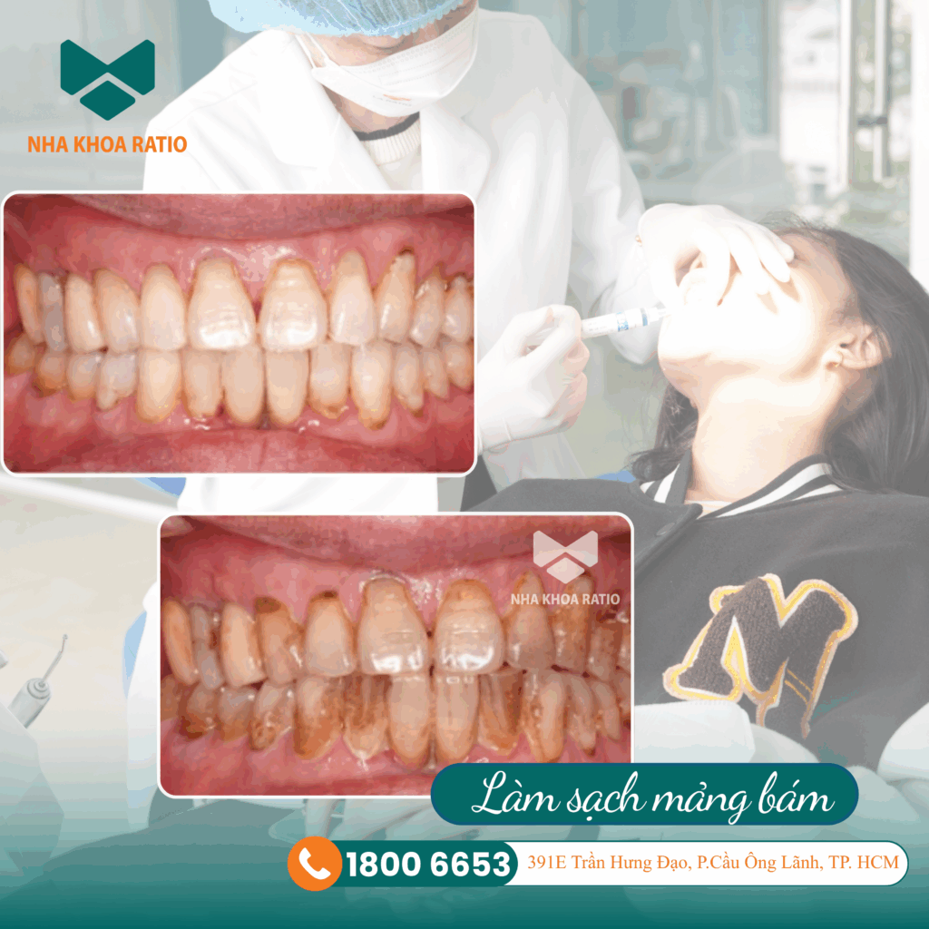  Răng lung lay Nha Khoa Ratio 