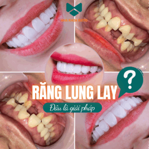 Răng lung lay Nha Khoa Ratio