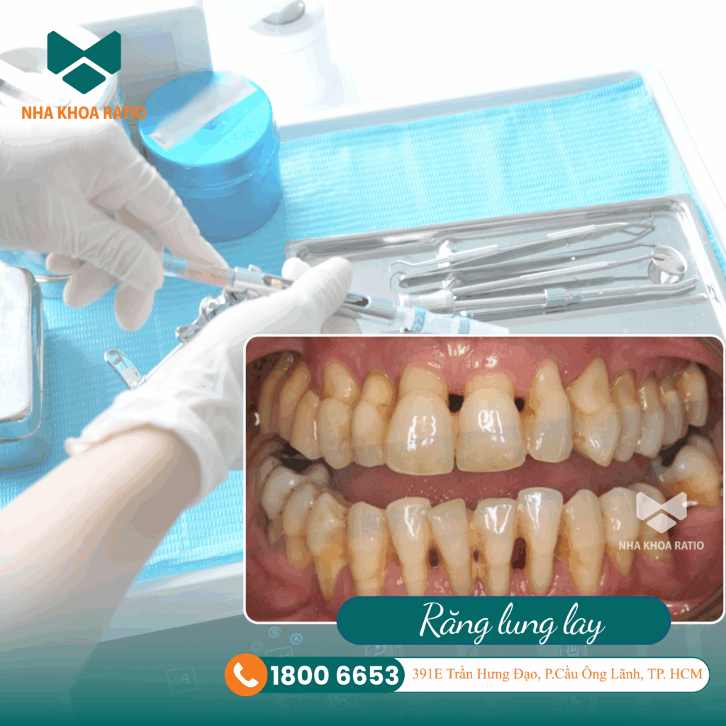 Nha Khoa Ratio Răng lung lay