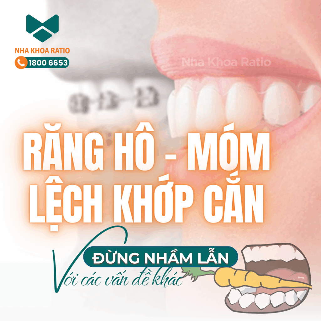 Nha khoa Ratio - răng hô móm lệch khớp cắn