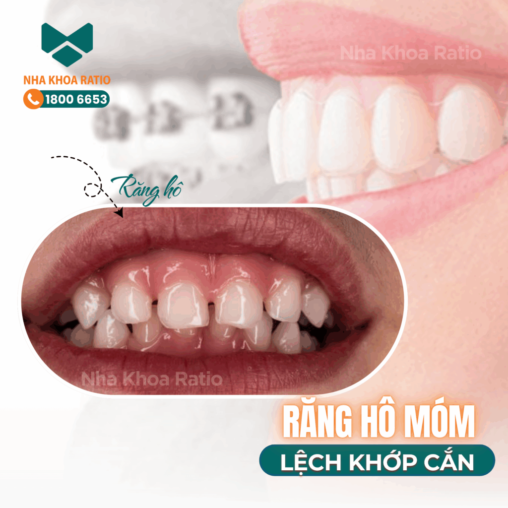 Nha khoa Ratio - răng hô móm lệch khớp cắn