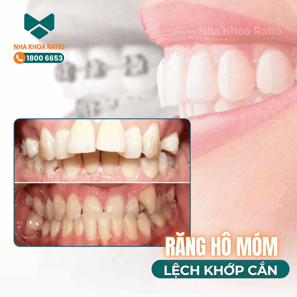 Nha khoa Ratio - răng hô móm lệch khớp cắn