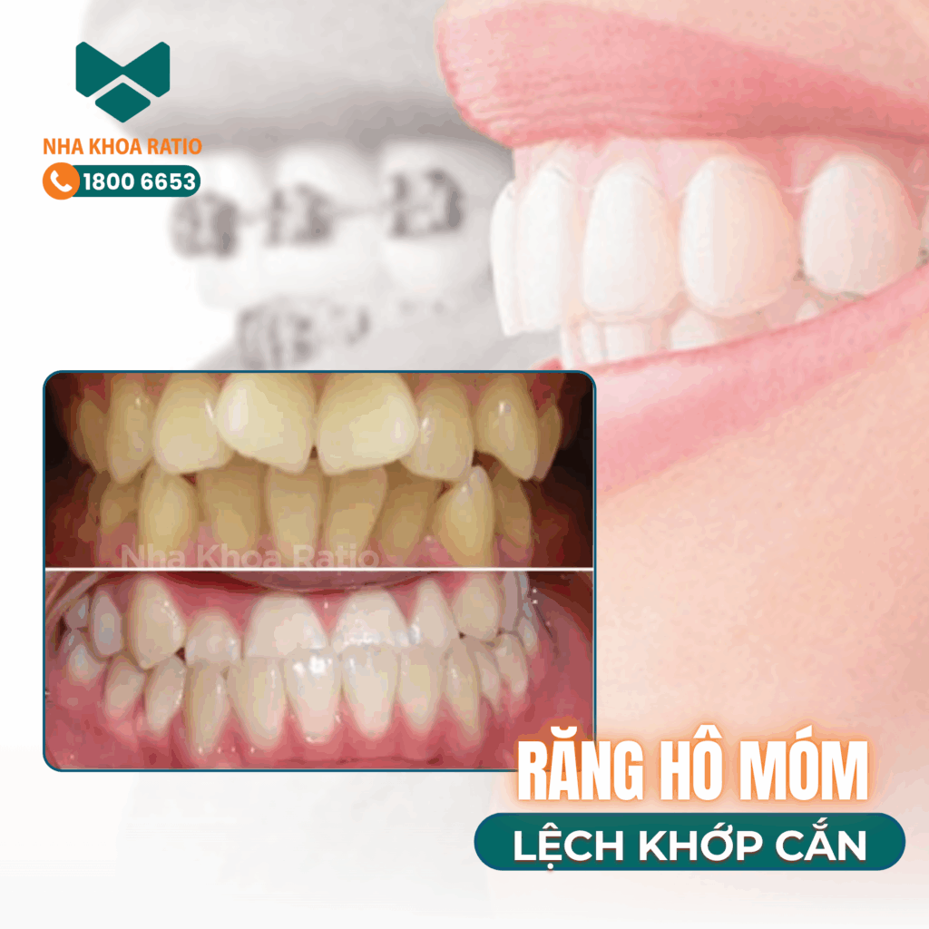 Nha khoa Ratio - răng hô móm lệch khớp cắn