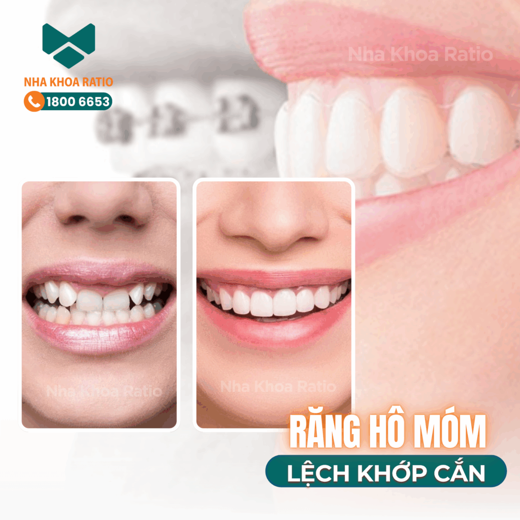 Nha khoa Ratio - răng hô móm lệch khớp cắn