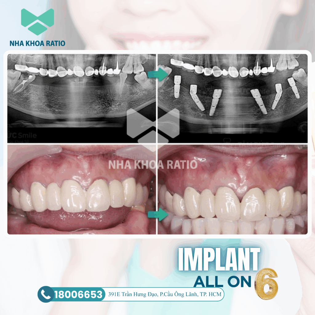Răng Implant 