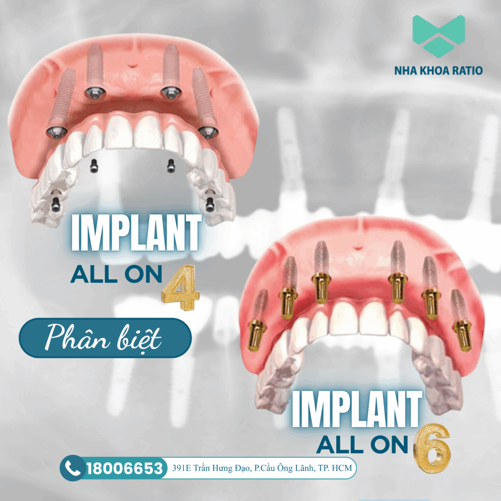 Trồng răng Implant 