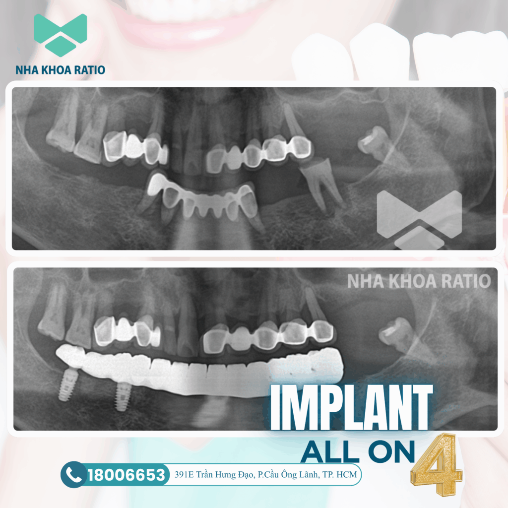 Răng Implant 