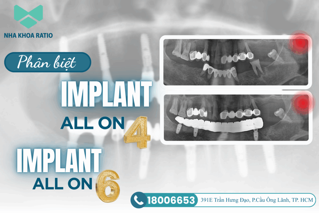 Cấy ghép implant