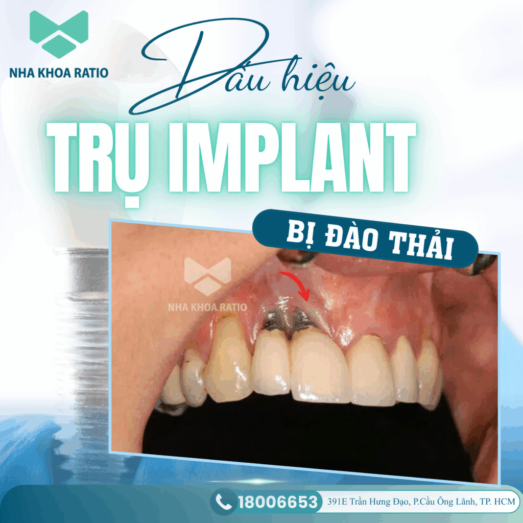 Dấu hiệu đào thải Trụ Implant