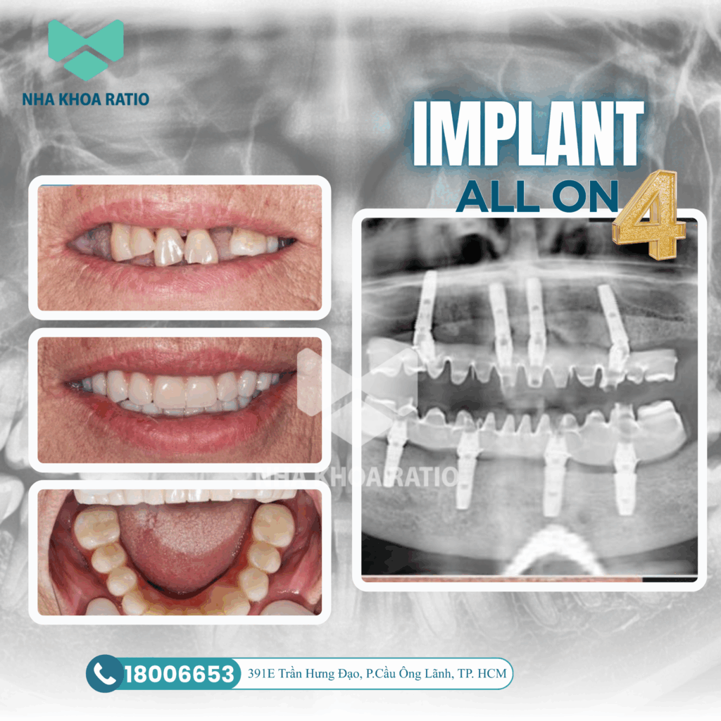 Răng Implant 