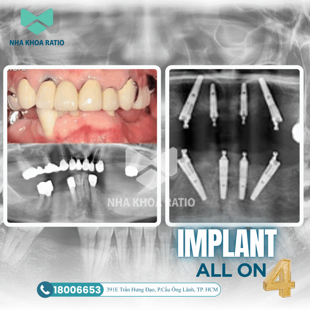 Răng Implant 
