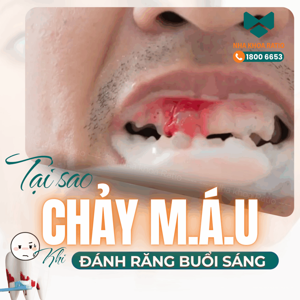 Răng chảy máu khi đánh răng nha khoa Ratio