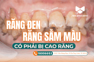 Răng đen răng sẩm màu Nha khoa Ratio