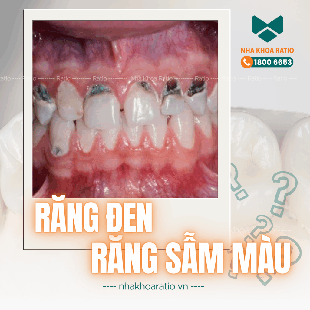 Răng đen răng sẩm màu Nha khoa Ratio