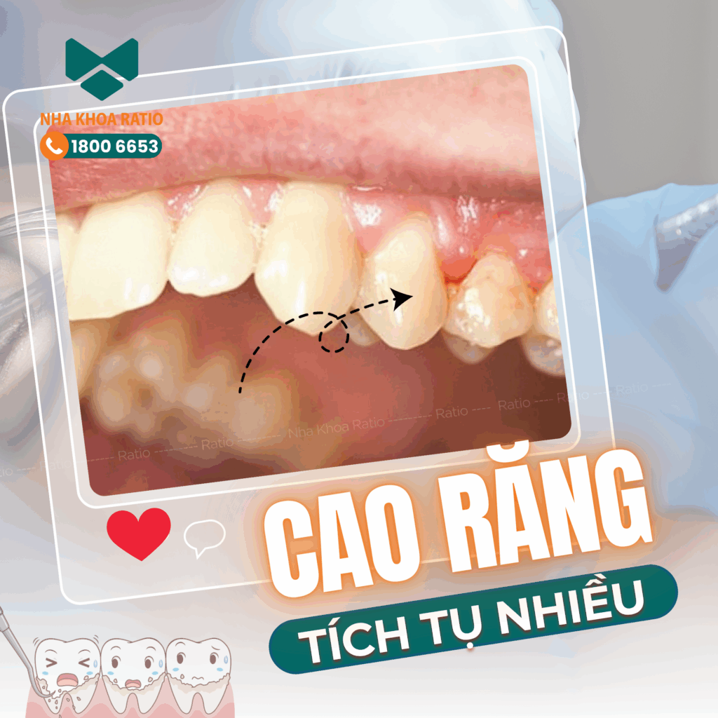  cao răng tích tụ nhiều  Nha khoa Ratio 