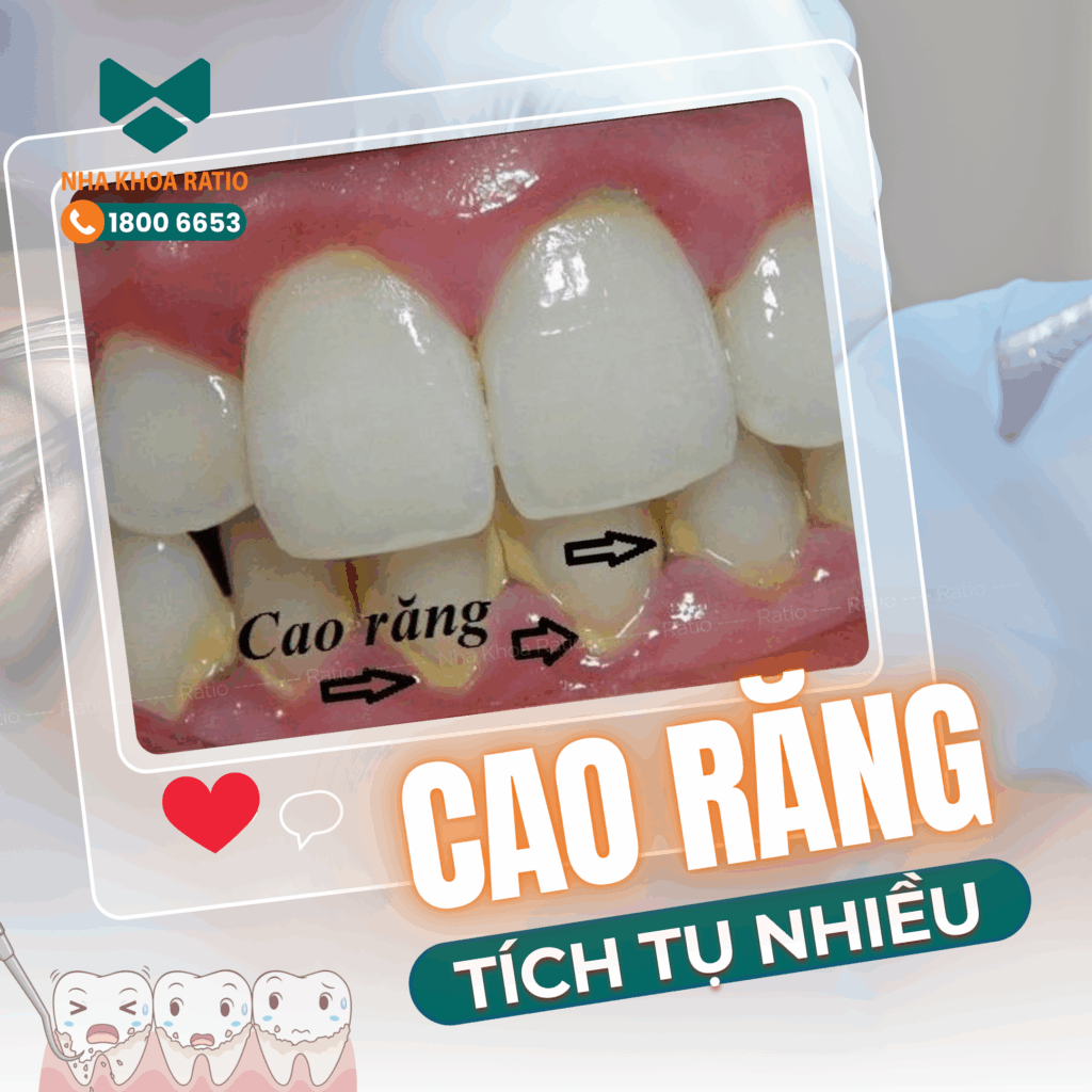  cao răng tích tụ nhiều  Nha khoa Ratio 