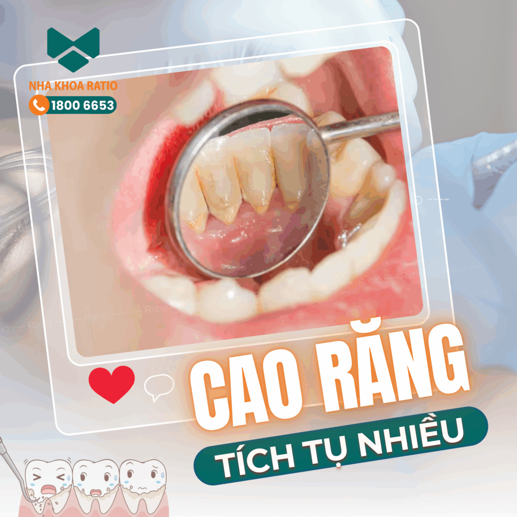  cao răng tích tụ nhiều  Nha khoa Ratio 