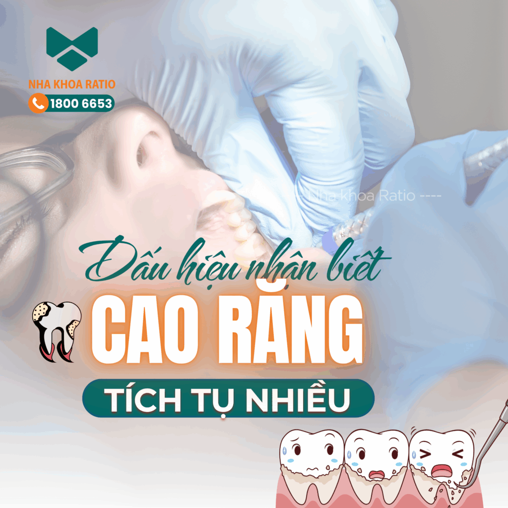  cao răng tích tụ nhiều  Nha khoa Ratio 