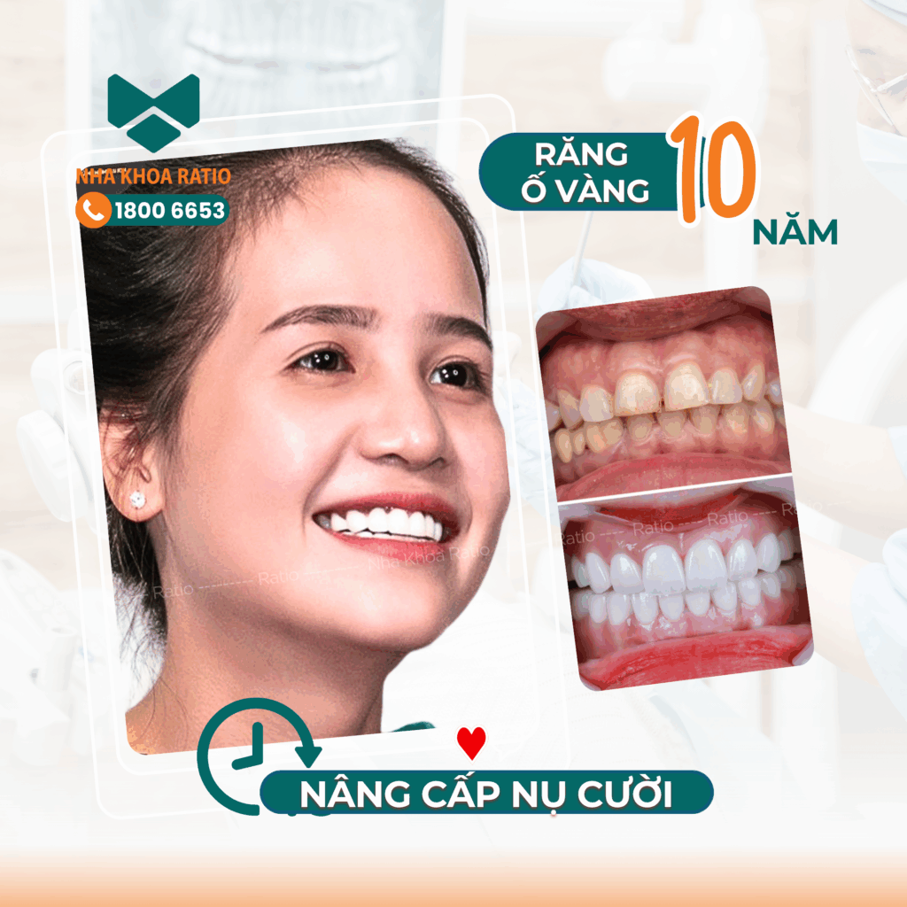 Tự tin vì răng ố vàng điều trị tại Nha Khoa Ratio Tự tin vì răng ố vàng điều trị tại Nha Khoa Ratio