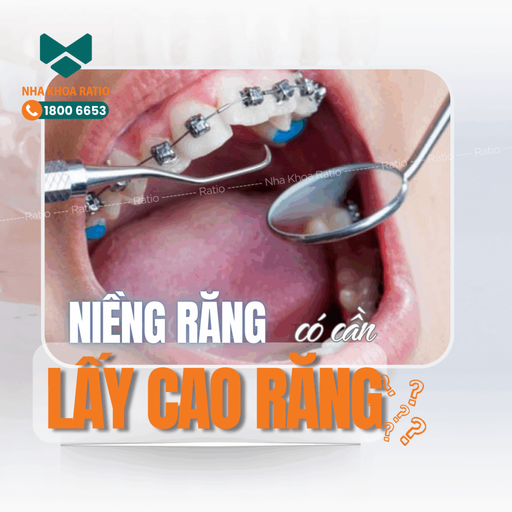 Niềng răng nha khoa Ratio