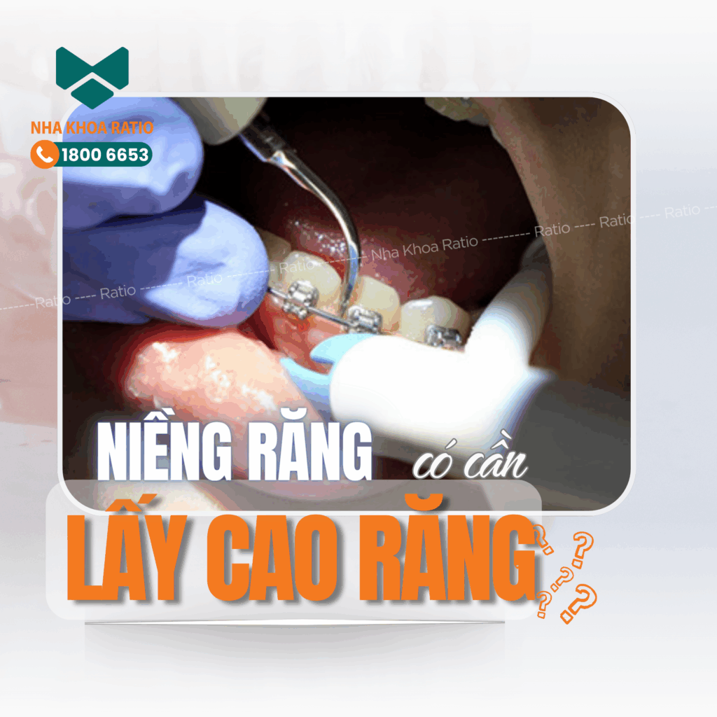 Niềng răng nha khoa Ratio