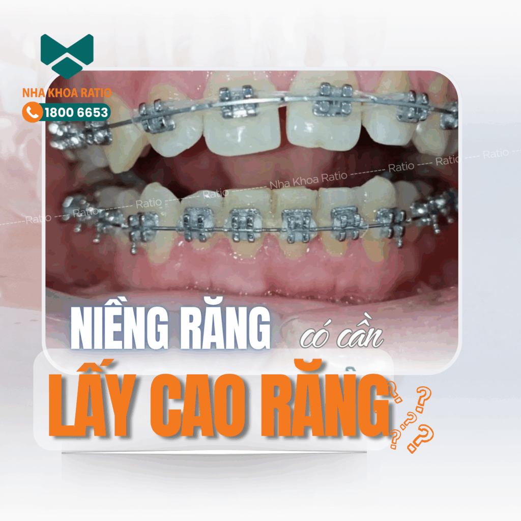 Niềng răng nha khoa Ratio