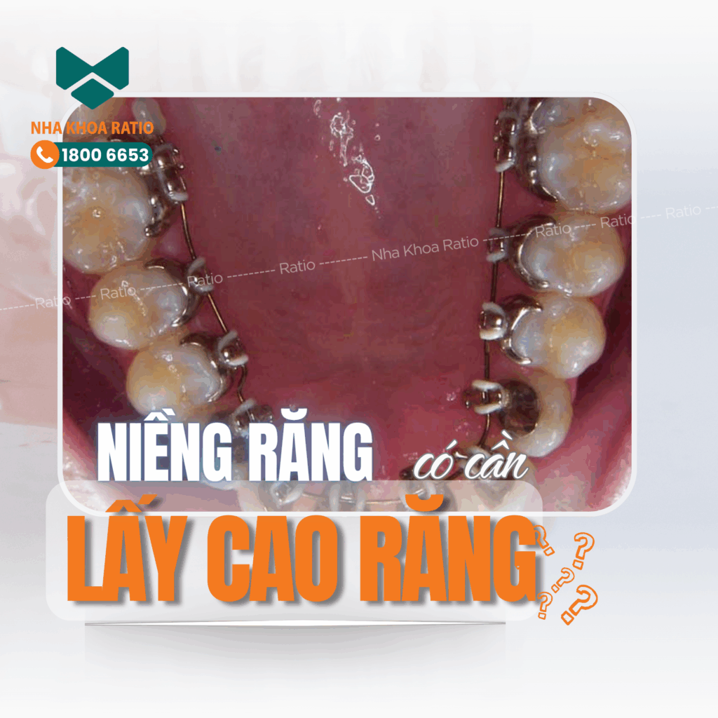 Niềng răng nha khoa Ratio