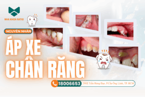 ÁP XE CHÂN RĂNG nha khoa Ratio