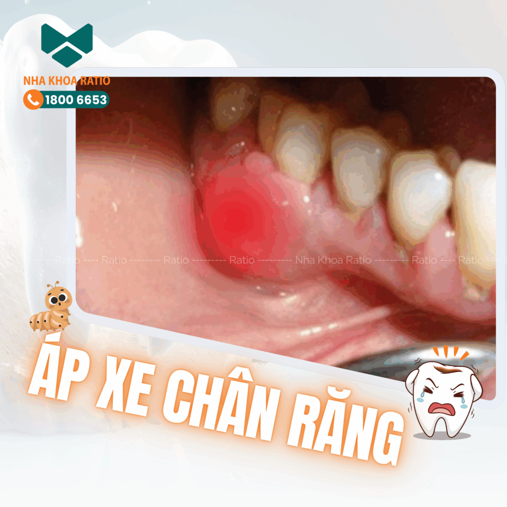 ÁP XE CHÂN RĂNG nha khoa Ratio