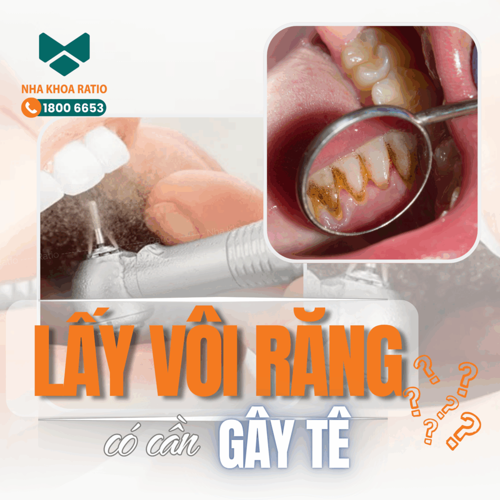 Lấy vôi răng Nha Khoa Ratio