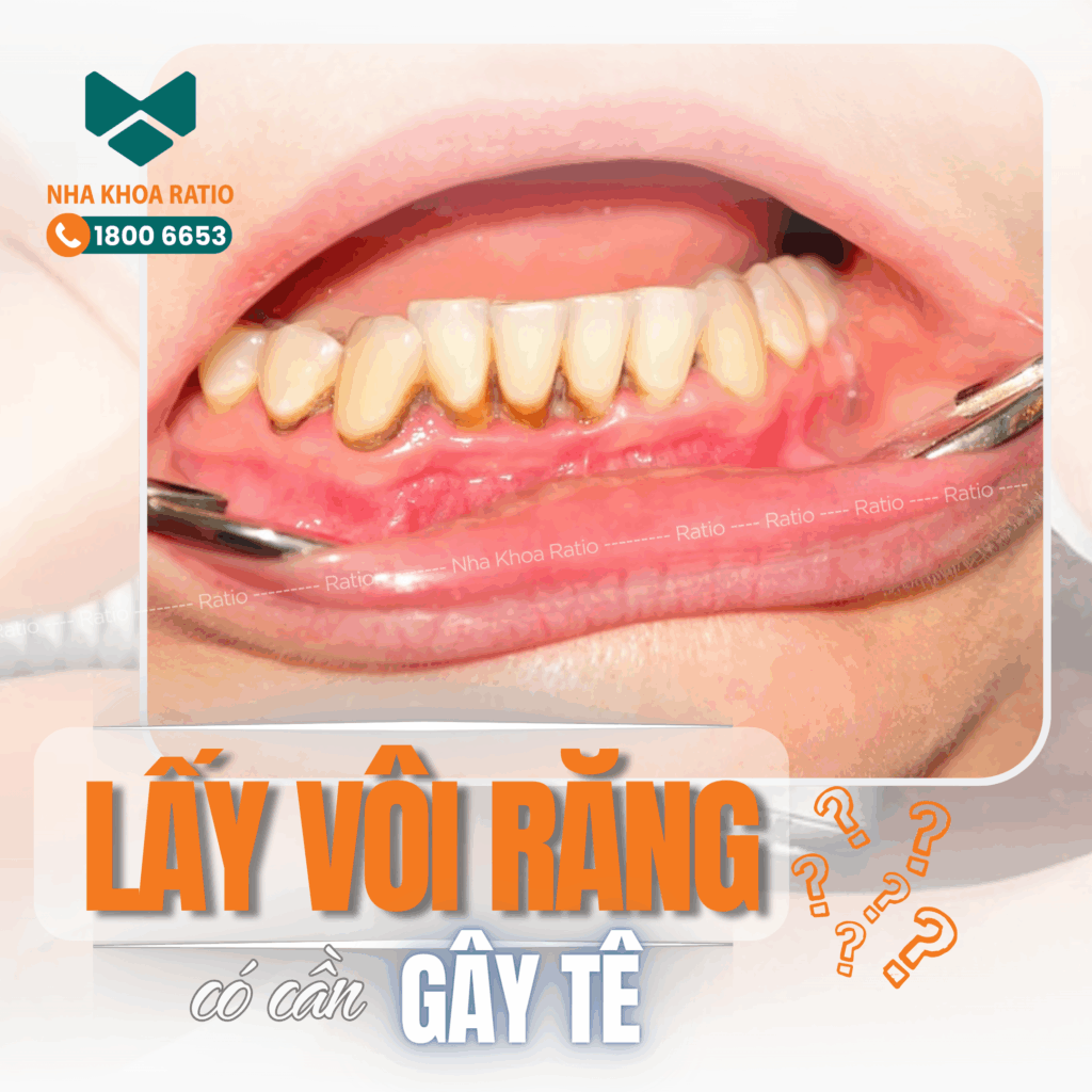 Lấy vôi răng Nha Khoa Ratio