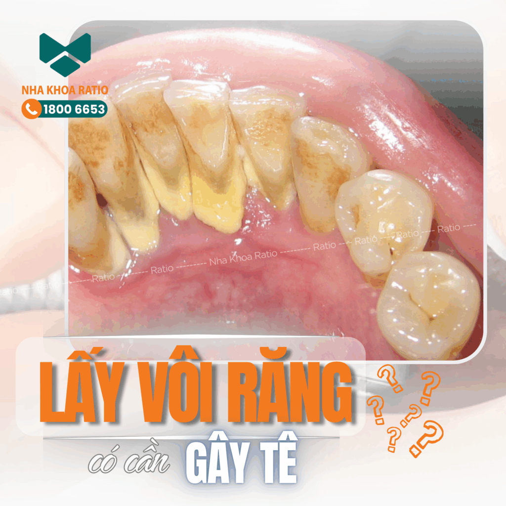 Lấy vôi răng Nha Khoa Ratio